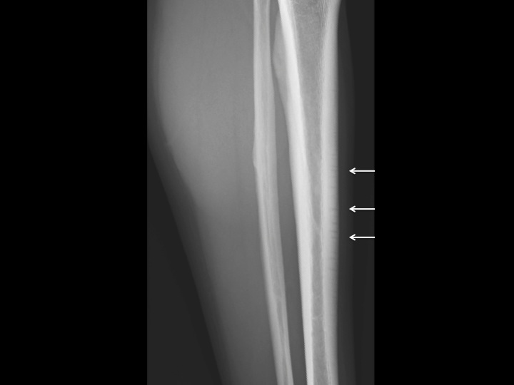 Figure 2 for case stress fracture ( RID4695 )